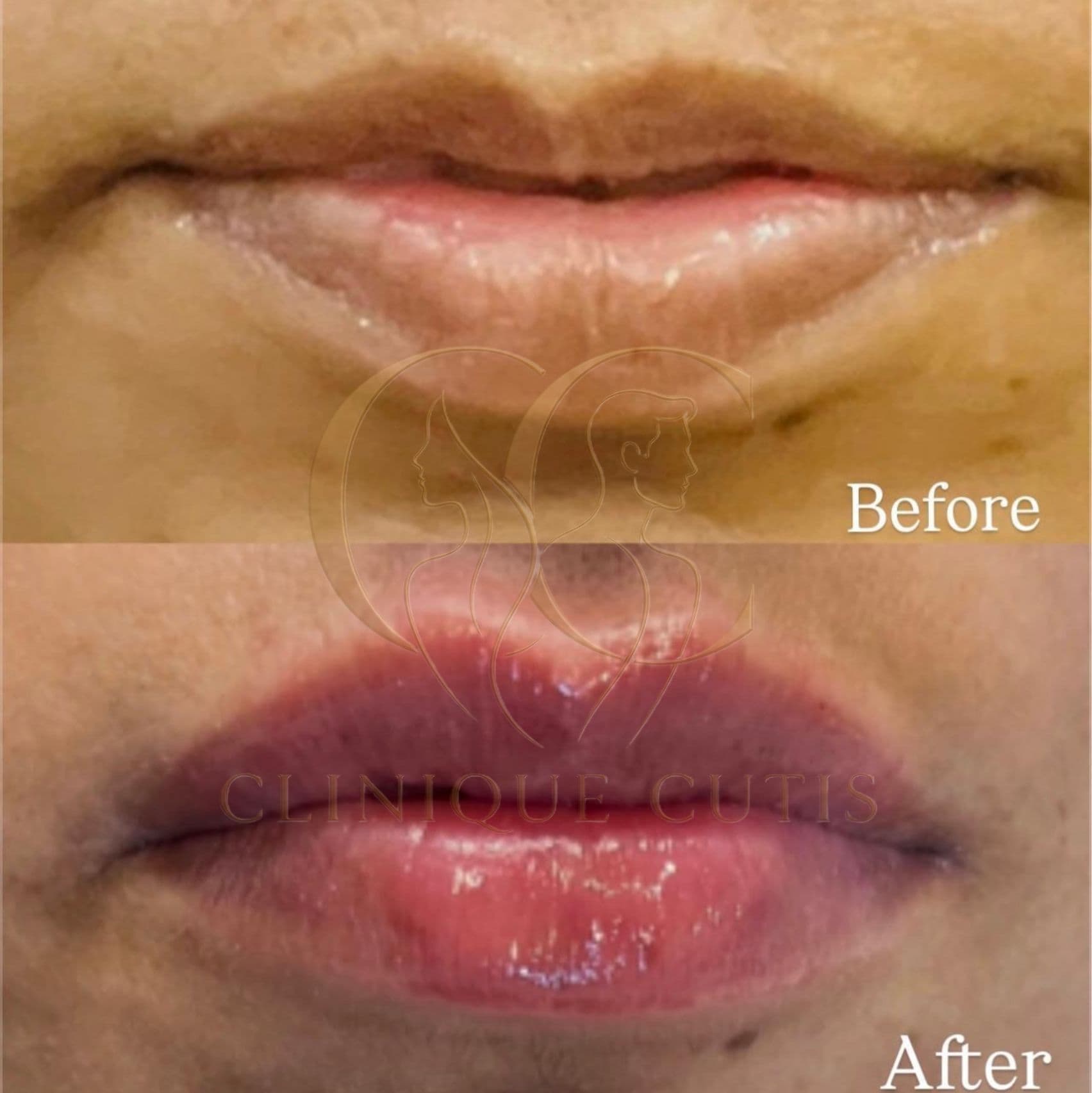 3D Lip Fillers