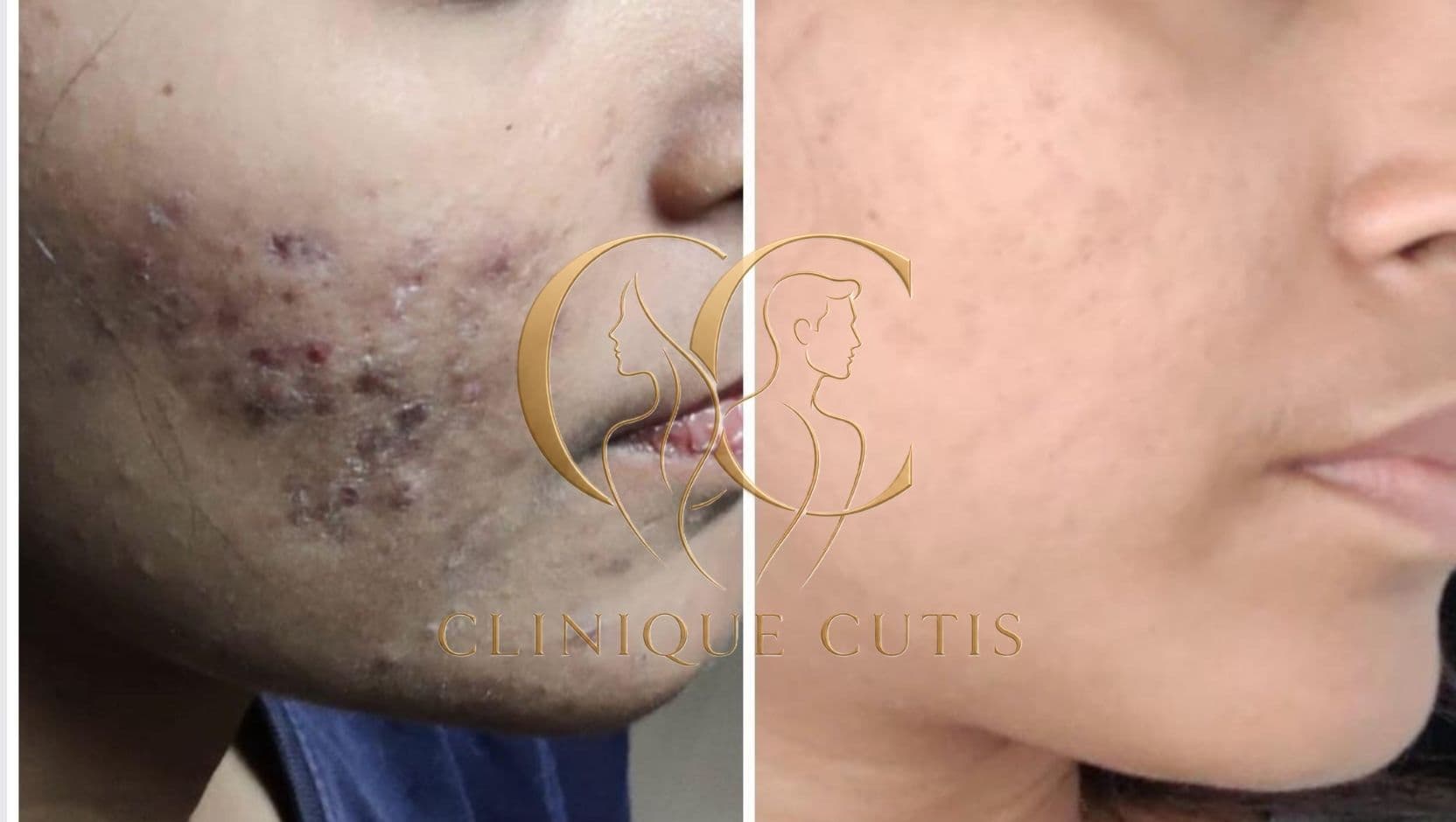 Acne & Dark Spot Treatment