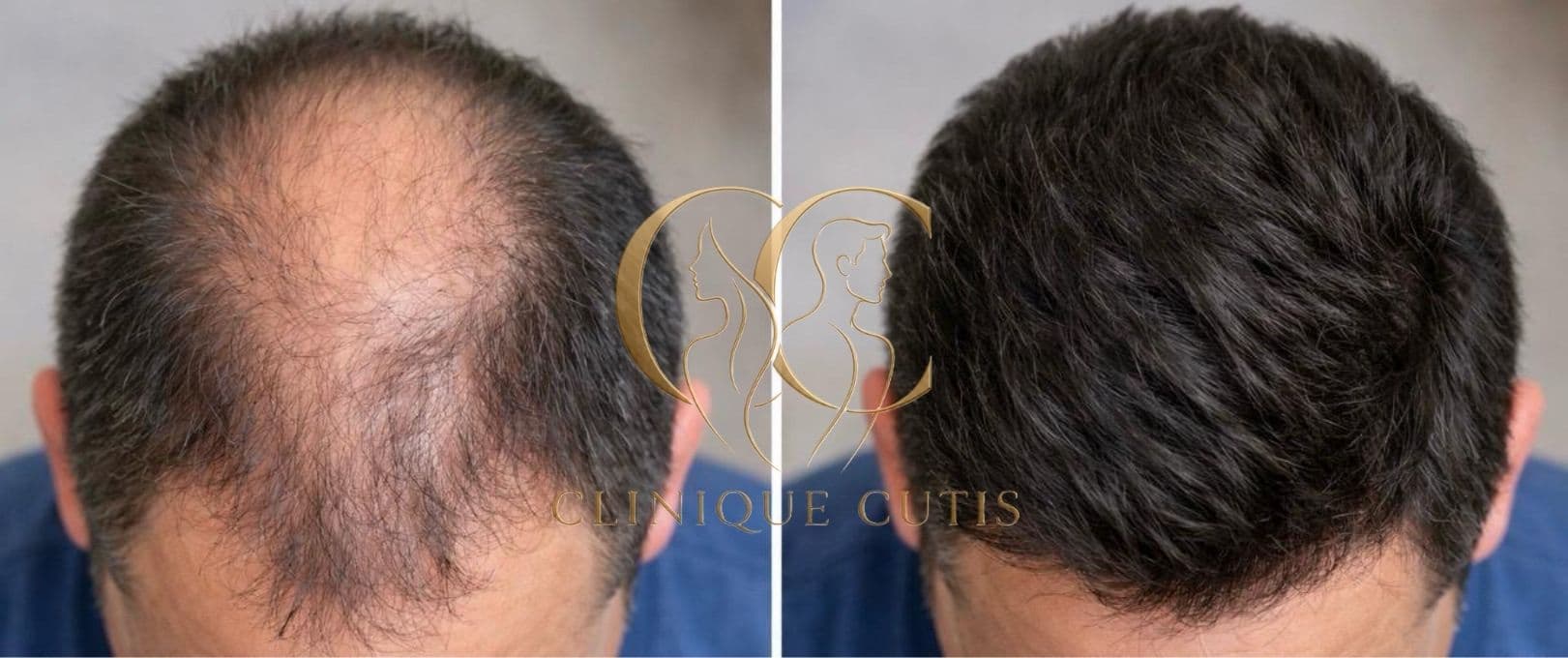 Hair Regrowth Therapy