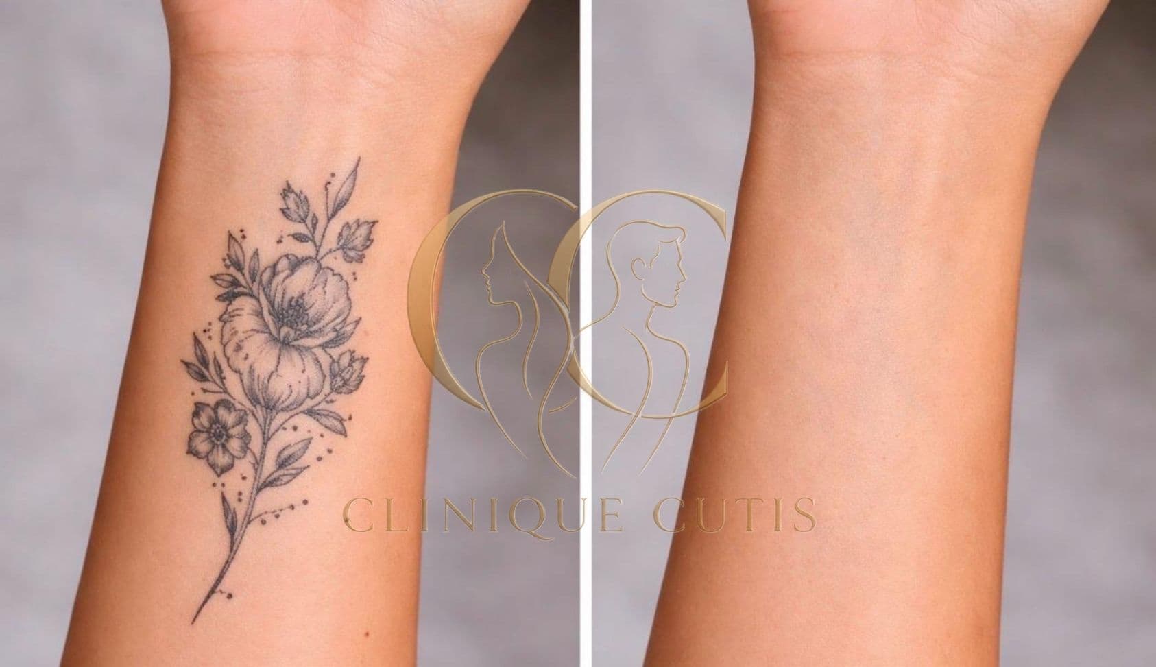 Tattoo Removal