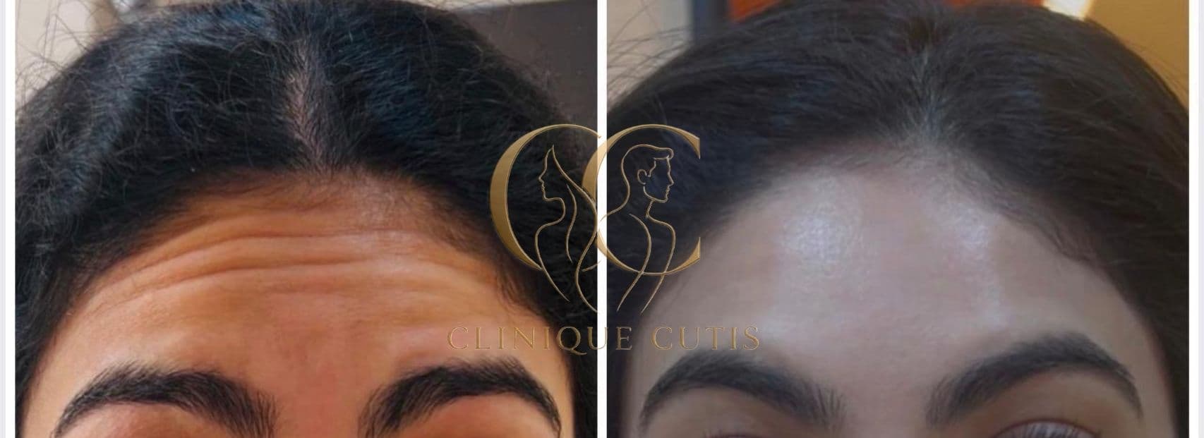 Wrinkle Removal