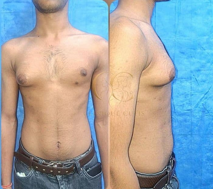 Gynaecomastia Surgery
