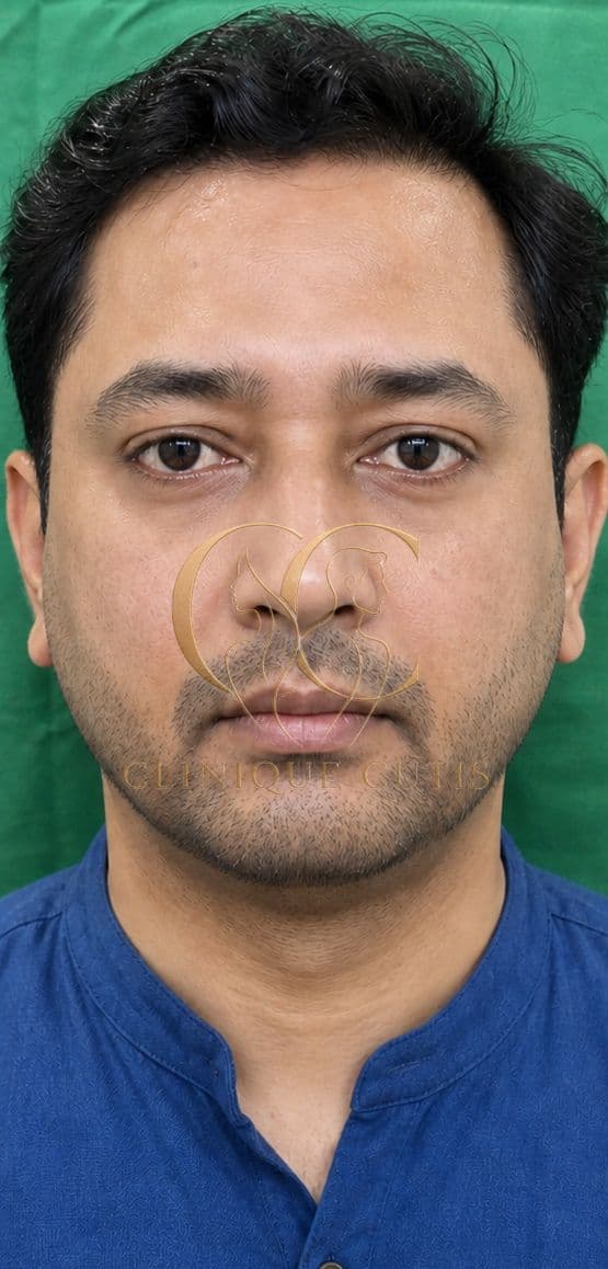 After Lower Blepharoplasty