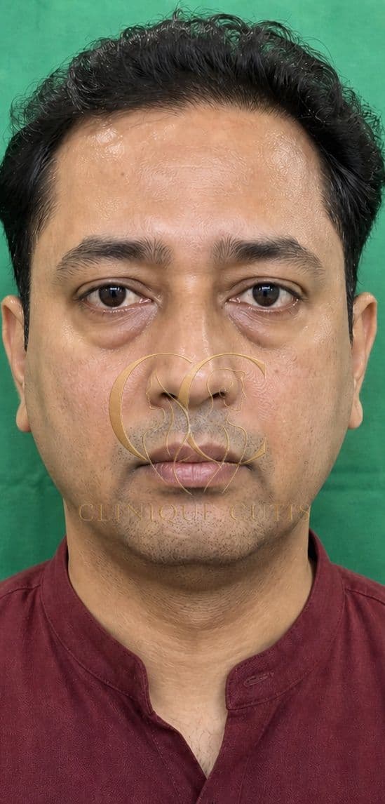 Before Lower Blepharoplasty