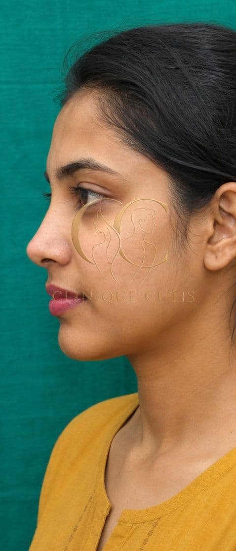 After Rhinoplasty