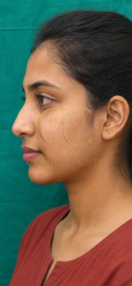 Before Rhinoplasty
