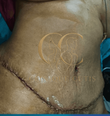 After Tummy Tuck