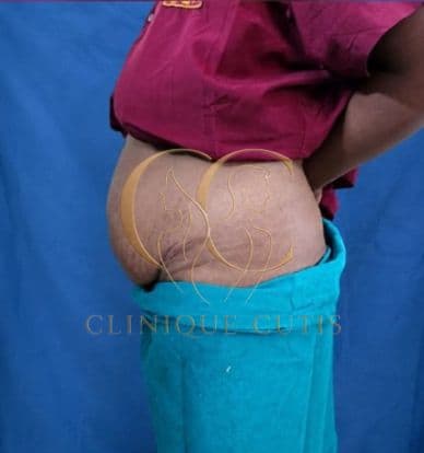 Before Tummy Tuck